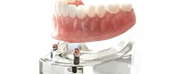 Implant denture replacing full row of teeth