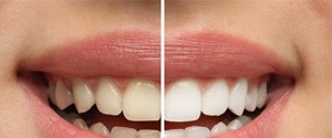 Closeup of woman's smile before and after teeth whitening 