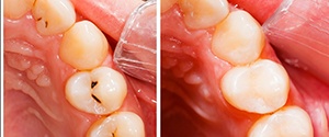before and after a dental filling