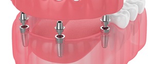 Digital illustration of dental implant dentures.