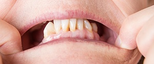 closeup of a mouth with missing teeth