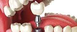 Parts of a single tooth dental implant and crown