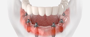 an example of implant dentures in Agawam