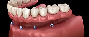 a digital illustration of an implant denture