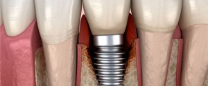 Illustration of infection around a dental implant