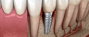 Illustration of a single dental implant