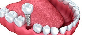 Diagram of dental implants in Agawam