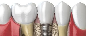 Closeup diagram of dental implants in Agawam 