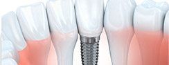 illustration of dental implant