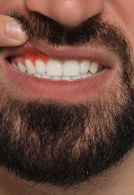 Man lifting upper lip to reveal darkened gum tissues
