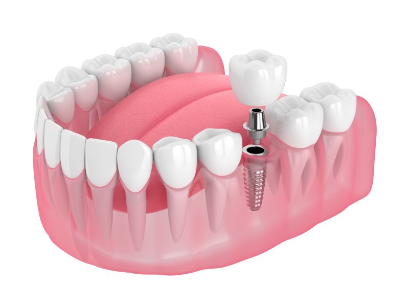 3D render of dental implant in jaw 