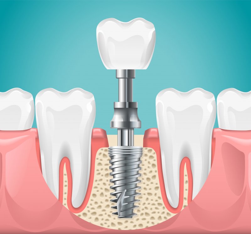 Illustration of dental implants