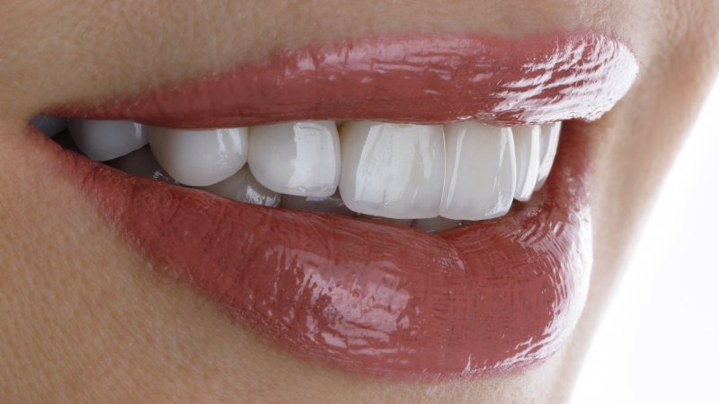 Close-up of teeth with porcelain veneers