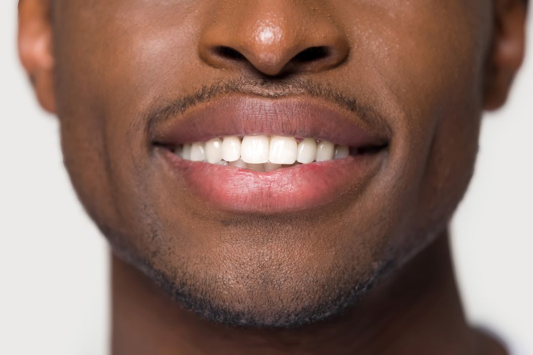 Will My Diet Change if I Get Veneers? Dr. Frank Michitti