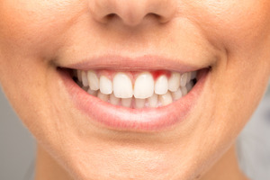 Woman with signs of gum disease